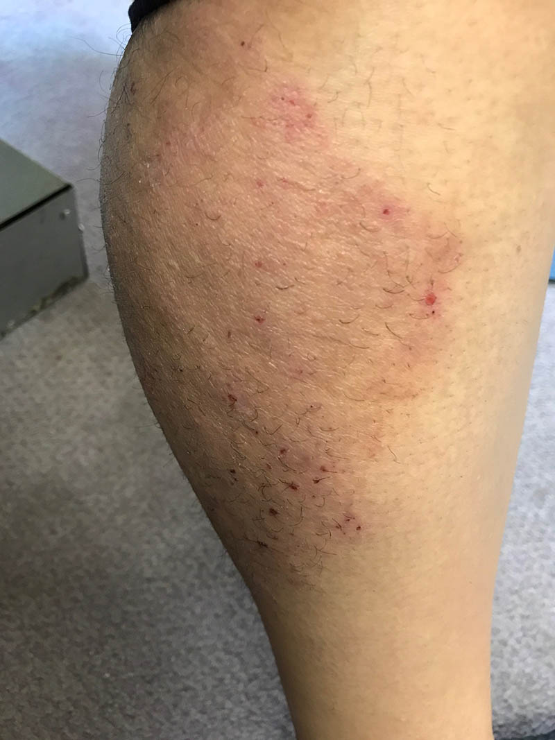 What Eczema, Insomnia, Weight Gain, Fatigue, Anxiety and Depression All