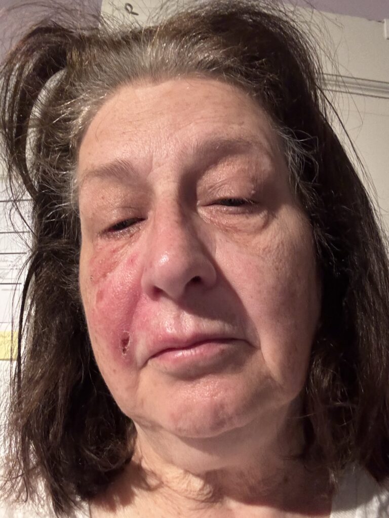 A patient with a major abscess on her upper right first bicuspid tooth.