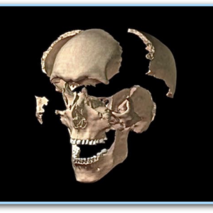 Reverse Sphenobasilar Motion Online Masterclass